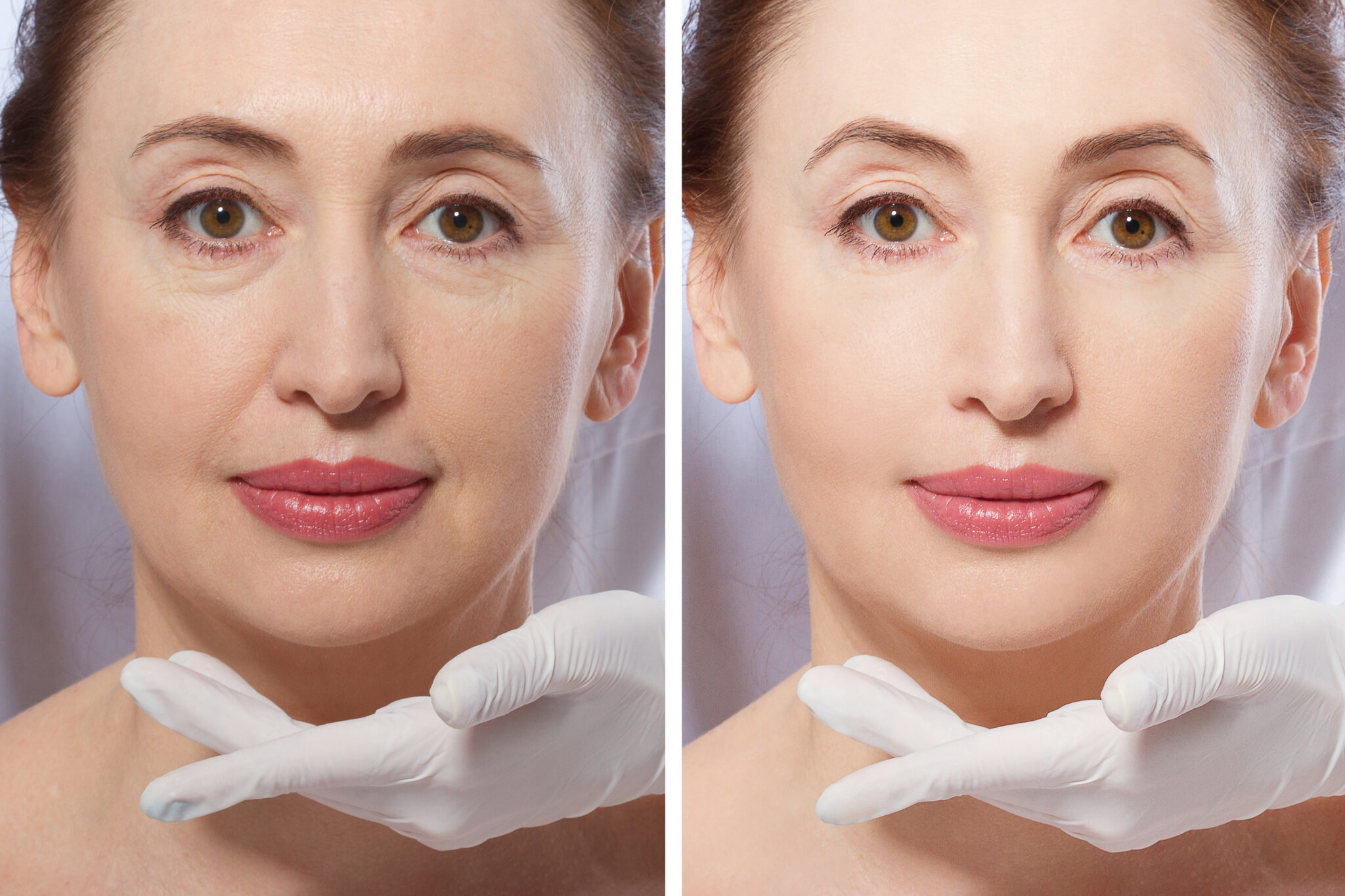 Facelifts Lake Ear, Nose, Throat & Facial Plastic Surgery